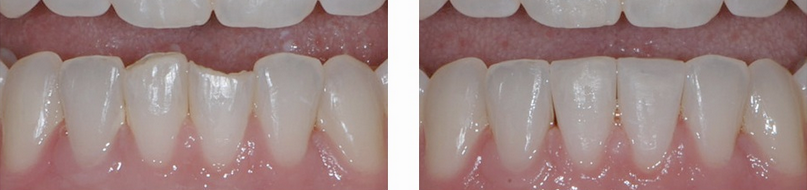 تكسر الاسنان